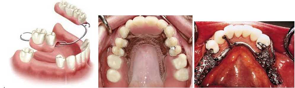 partial_dentures