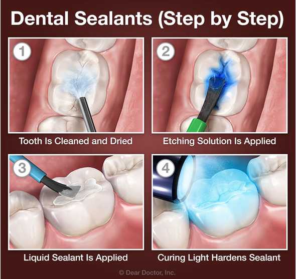 dental_sealants